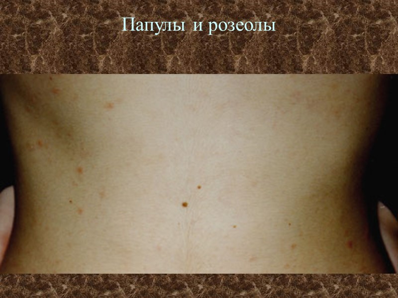 Папулы и розеолы